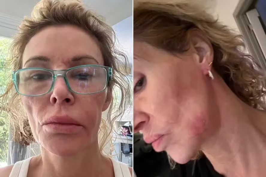 Estrela de reality nos EUA diz que vai remover pele de rosto para investigar suposto parasita