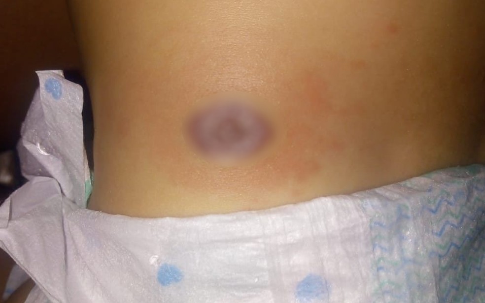 Ferimento onde Ayslla Helena Souza Lopes tomou injeção, ela morreu em Trindade, Goiás — Foto: Reprodução/TV Anhanguera