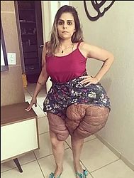 Em cirurgia inédita no Brasil