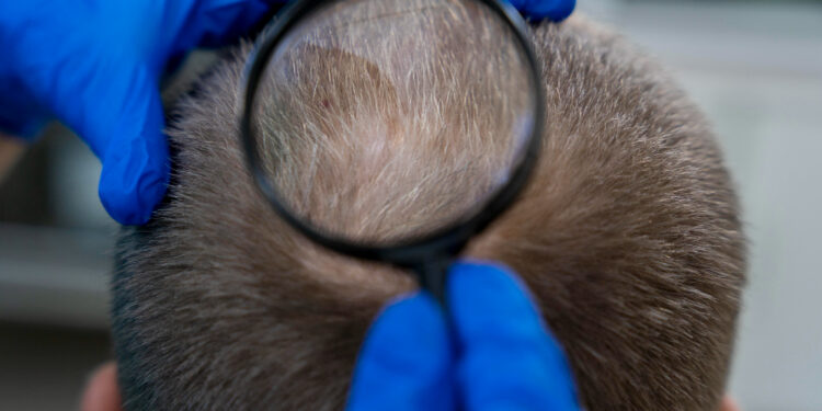 Adeus, minoxidil: esse é o tratamento mais avançado do mundo contra a calvície sem precisar de cirurgia