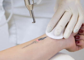 Remoção de tatuagens: qual o valor e quantas sessões são necessárias para apagar tudo de vez