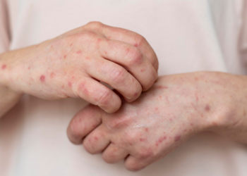 Ministério da Saúde emite alerta urgente e casos de Mpox disparam no Brasil