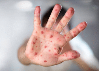 Governo liga o alerta vermelho após doença letal se espalhar pelo Brasil