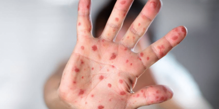 Governo liga o alerta vermelho após doença letal se espalhar pelo Brasil