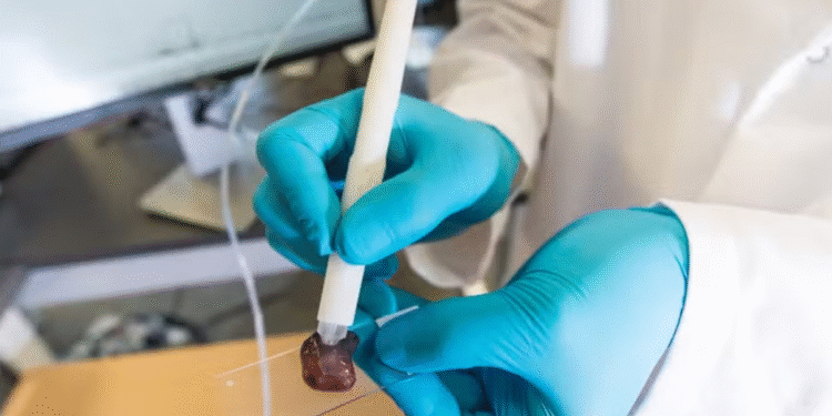 Caneta criada por brasileira detecta o câncer em apenas 10 segundos