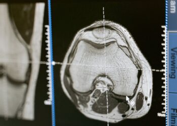 Esse foi o único sintoma antes de derrame em jovem de 20 anos