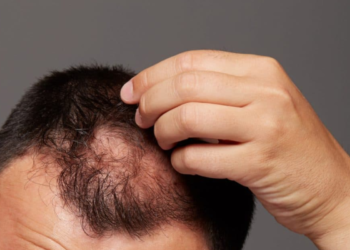 Anvisa determinou suspensão do produto e quem compra minoxidil precisa saber disso