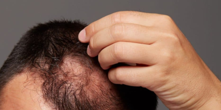 Anvisa determinou suspensão do produto e quem compra minoxidil precisa saber disso