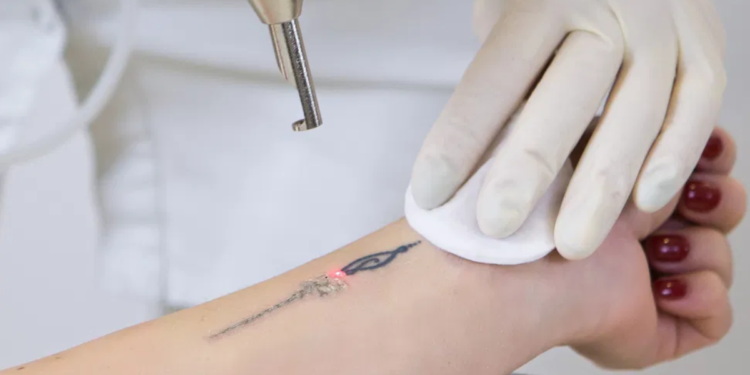 Remoção de tatuagens: qual o valor e quantas sessões são necessárias para apagar tudo de vez