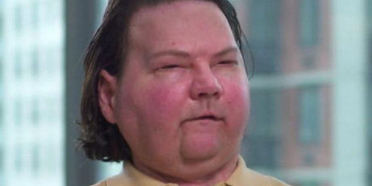 Homem que realizou transplante de rosto revela que só sobreviveu por conta da musculação