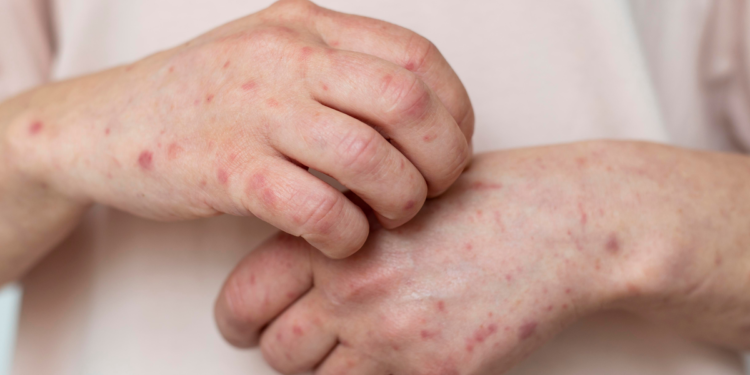 Ministério da Saúde emite alerta urgente e casos de Mpox disparam no Brasil